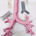 Stent 2